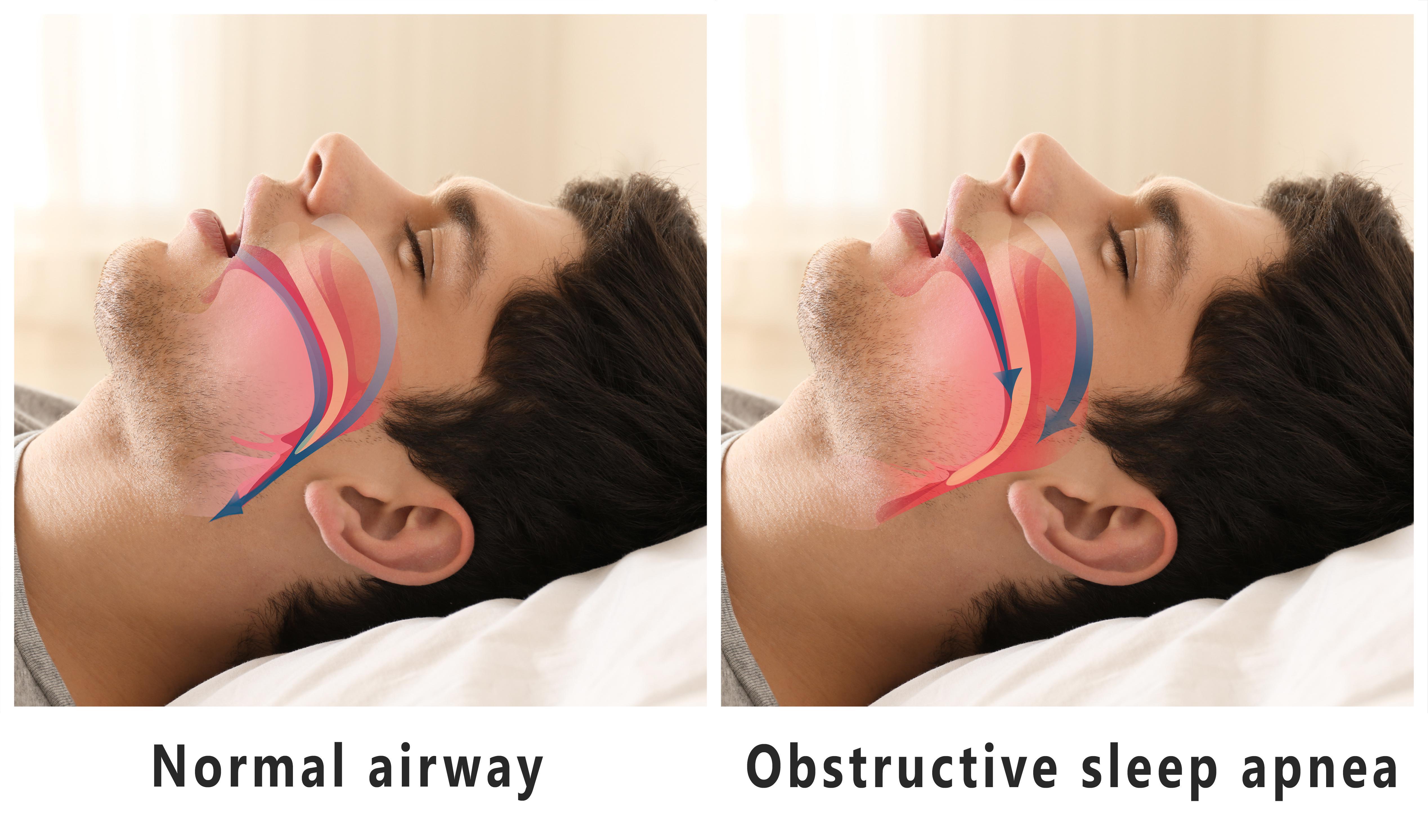 DO YOU HAVE OBSTRUCTIVE SLEEP APNEA? Join our study!